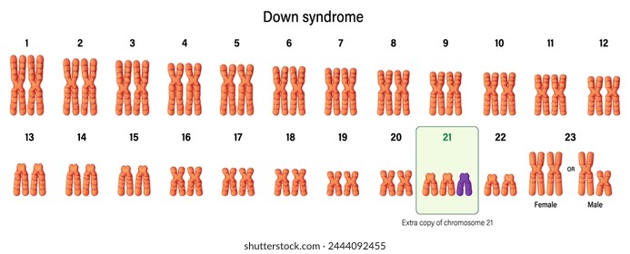 cariotipo del síndrome de Down. Anomalías autosómicas. Trisomía 21. Trastorno genético causado cuando la división celular anormal da lugar a un llenado extra.