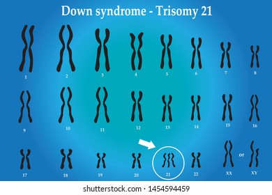 Karyotype Of Down Syndrome (DS Or DNS), Also Known As Trisomy 21, Is A Genetic Disorder Caused By The Presence Of All Or Part Of A Third Copy Of Chromosome 21