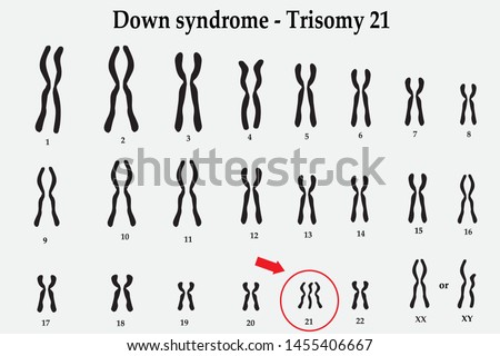 Karyotype of Down syndrome (DS or DNS), also known as trisomy 21, is a genetic disorder caused by the presence of all or part of a third copy of chromosome 21