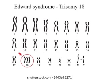 Karyotype of Edward syndrome also known as trisomy 18, is a genetic disorder caused by the presence of all or part of a third copy of chromosome 18.