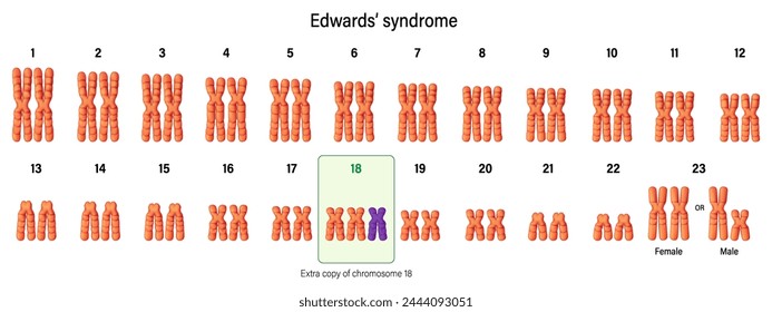 Karyotyp des Edwards-Syndroms. Autosomale Anomalien. Trisomie 18. Genetische Störung. Chromosomenstörung, die oft zu Totgeburten führt.