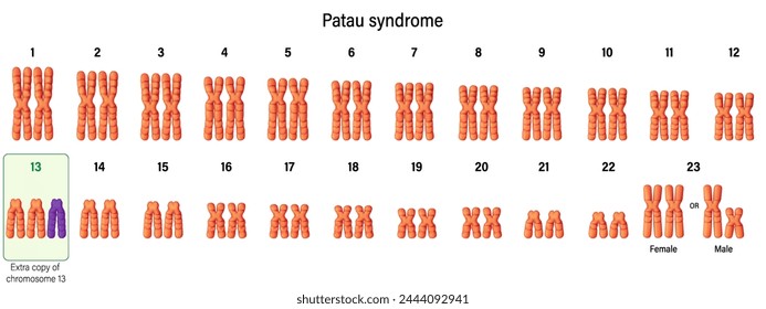Karyotype of Patau syndrome. Autosomal abnormalities. Trisomy 13. Genetic disorder. 