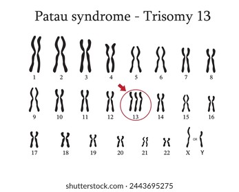 Karyotype of Patau syndrome also known as trisomy 13, is a genetic disorder caused by the presence of all or part of a third copy of chromosome 13.