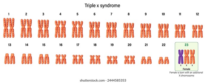 Karyotype of Triple x syndrome. Female has an extra X chromosome. Chromosome abnormality.