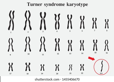 Karyotype of Turner syndrome (TS), also known 45,X, or 45,X0, is a genetic condition in which a female is partly or completely missing an X chromosome