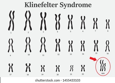 Karyotype of Klinefelter’s or XXY usually in male is born with an extra X chromosome (XXY). 