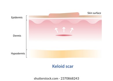 Keloid scar on skin surface vector illustration isolated on white background. Cross section of keloid scar spread beyond the borders of the initial injury, showing overgrowth of scar margin.