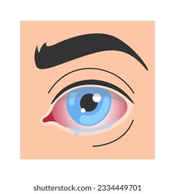 Keratitis Human Eye Disease Vector Illustration