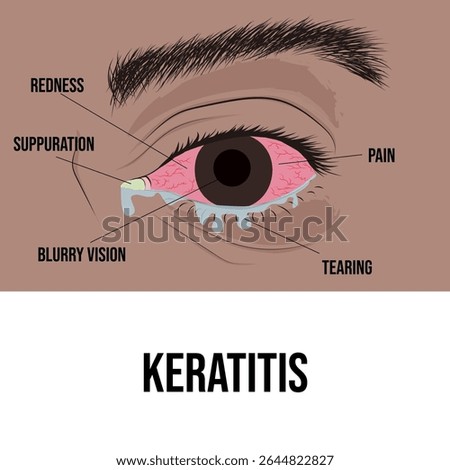 Keratitis, inflammation of the cornea, the transparent part of the eye.