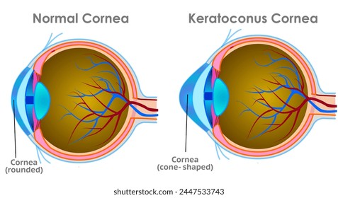 Queratocono corneal, astigmatismo véase. Anatomía ocular, estructura óptica de la retina. Incluye córnea, iris y pupila. Queratoplastia corneal. Ilustración vectorial