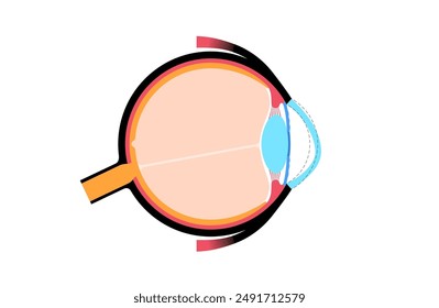 Keratoconus degenerate shape of human eye. Cataract disease, eye and pupil anatomy. Lens clouding, vision impairment, blindness. Vision problems during aging. Human vision loss vector illustration