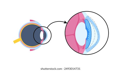 Keratoconus degenerate shape of human eye. Cataract disease, eye and pupil anatomy. Lens clouding, vision impairment, blindness. Vision problems during aging. Human vision loss vector illustration