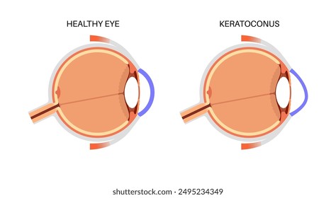 Keratoconus degenerate shape of human eye. Cataract disease, eye and pupil anatomy. Lens clouding, vision impairment, blindness. Vision problems during aging. Human vision loss vector illustration