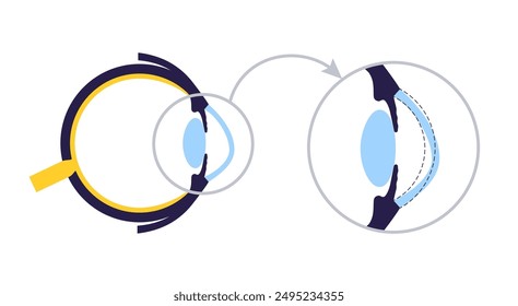 Queratocono forma degenerada del ojo humano. Enfermedad de cataratas, anatomía ocular y pupilar. Opacidad del cristalino, deterioro de la visión, ceguera. Problemas de visión durante el envejecimiento. Ilustración vectorial de pérdida de visión humana