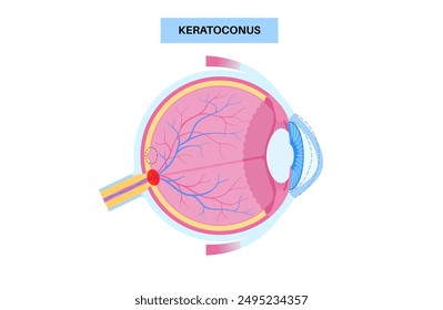 Queratocono forma degenerada del ojo humano. Enfermedad de cataratas, anatomía ocular y pupilar. Opacidad del cristalino, deterioro de la visión, ceguera. Problemas de visión durante el envejecimiento. Ilustración vectorial de pérdida de visión humana