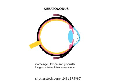 Keratoconus degenerate shape of human eye. Cataract disease, eye and pupil anatomy. Lens clouding, vision impairment, blindness. Vision problems during aging. Human vision loss vector illustration