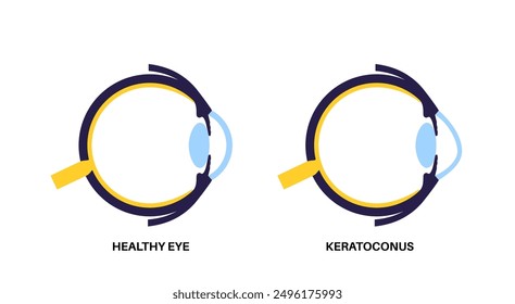 Forma degenerada del queratocono del ojo humano. Enfermedad de cataratas, anatomía de los ojos y las pupilas. Enturbiamiento del cristalino, discapacidad visual, ceguera. Problemas de visión durante el envejecimiento. Ilustración vectorial de pérdida de la visión humana