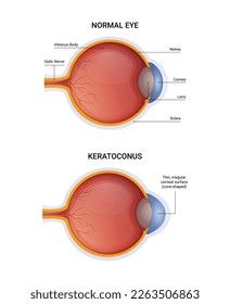 Keratoconus disease vector infographic, normal eye and keratoconus illustration design