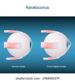 Keratoconus. disorder or disease of the eye. progressive thinning of the cornea. vector