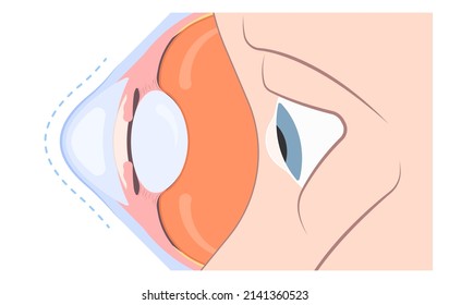 Keratoconus Dry Shape Eye Vision Loss Blurry Double Cloudy Myopia Lasik Glare Exam Atopy Vernal Retina