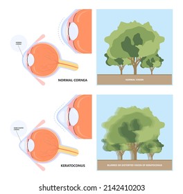 Keratoconus Dry Shape Eye Vision Loss Blurry Double Cloudy Myopia Lasik Glare Exam Atopy Vernal Retina