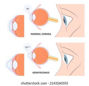 Keratoconus Dry Shape Eye Vision Loss Blurry Double Cloudy Myopia Lasik Glare Exam Atopy Vernal Retina