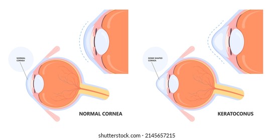 Keratoconus Dry Shape Eye Vision Loss Blurry Double Cloudy Myopia Lasik Glare Exam Atopy Vernal Retina