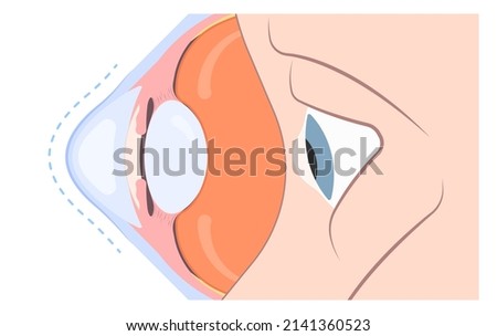Keratoconus dry shape eye vision loss blurry double cloudy myopia lasik glare exam atopy vernal retina