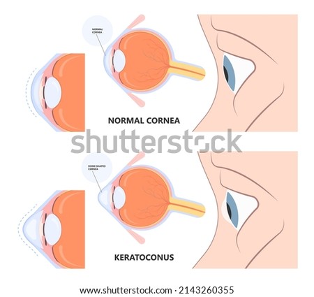 Keratoconus dry shape eye vision loss blurry double cloudy myopia lasik glare exam atopy vernal retina