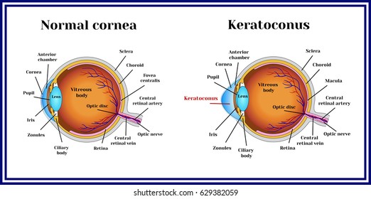 Keratoconus. Dystrophic Disease Of The Cornea.