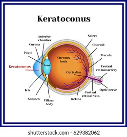 Keratoconus. Dystrophic disease of the cornea.