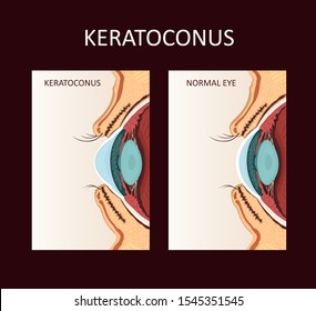 Keratoconus. Dystrophic disease of the cornea.  Medical Vector Illustration