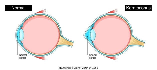 Queratocono. Trastorno ocular. Adelgazamiento corneal. Enfermedad ocular progresiva. Astigmatismo. Córnea irregular. Esquema. Ilustración vectorial detallada