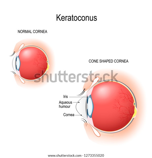 角錐体 角膜は正常で 角膜は円錐形 人間の目の解剖学 目とまぶたの垂直断面 回路図 詳細なイラスト 生物学 科学 医学用の のベクター画像素材 ロイヤリティフリー