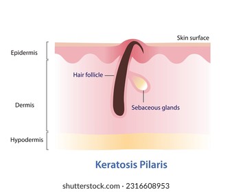 Keratosis Pilaris. Ingrown hair, Chicken skin vector illustration isolated on white background. Hair has grown back into the skin surface. Bumpy skin that looks like tiny pinpricks or goosebumps.