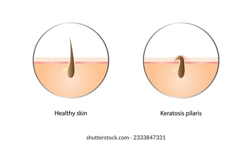 Keratosis pilaris, Ingrown hair, Chicken skin, Keratin plug and Bumpy skin. Hair has grown back into the skin. Difference between healthy skin, and follicular keratosis. Vector design.