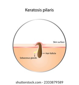 Keratosis pilaris, Ingrown hair, Chicken skin, Keratin plug and Bumpy skin. Hair has grown back into the skin. Difference between healthy skin, and follicular keratosis. Vector design.