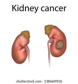 Kidney Cancer. Adrenal Glands, Ureters, Tumor. Realistic Anatomy Vector Illustration.