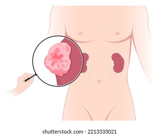 kidney cancer disease with Laparoscope donation minimally invasive surgery of Nephrectomy swelling organ artery tract stenosis	