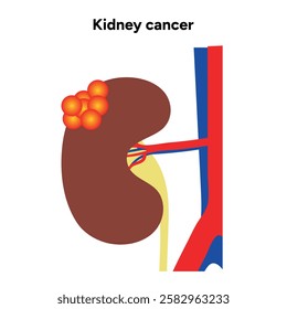 Kidney cancer disease Process in human. Medical problem Diagram