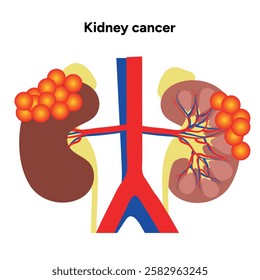 Kidney cancer disease Process in human. Medical problem Diagram