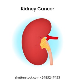 Kidney Cancer Disease Vector Illustration