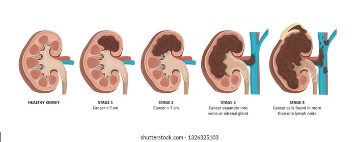 Kidney Cancer Stages. 