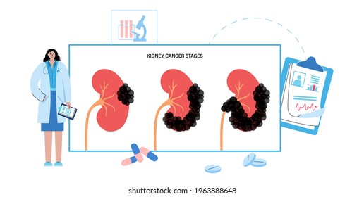 Kidney Cancer Stages, Pain And Inflammation. Oncology Disease In Urinary System Concept. Benign Or Malignant Tumor. Internal Organs Examination. Medical Poster With Doctor Flat Vector Illustration