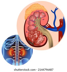 Kidney cancer. Tumor in section. Disease infographics. Realistic rendering of the human body and internal organs. Vector illustration