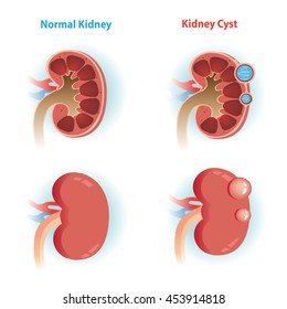 Kidney Cyst Disease And  Normal Kidney.Vector Illustrations