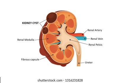 Kidney Cyst Vector Illustrations Stock Vector (Royalty Free) 1316231828 ...