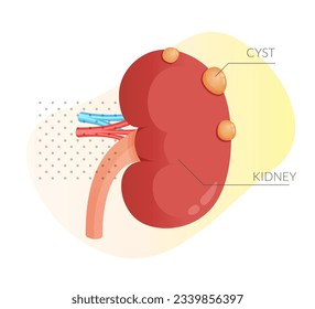 Kidney Cysts - Round Pouches of Fluid on Kidney - Stock Illustration as EPS 10 File