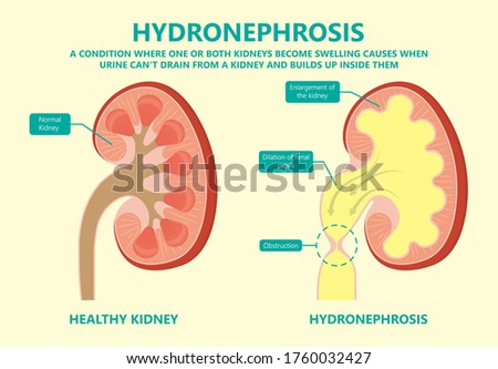 kidney damage UTI scan test tube VCUG acute VUR cyst exam flow pain birth block blood fetal fetus renal stone tract treat tumor urine x-ray cancer defect pelvic pelvis reflux sample system enlarge