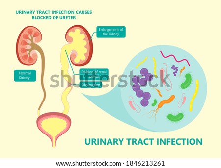 kidney damage UTI scan test tube VCUG acute VUR cyst exam flow pain birth block blood fetal fetus renal stone tract treat tumor urine x-ray cancer defect pelvic pelvis reflux sample system enlarge